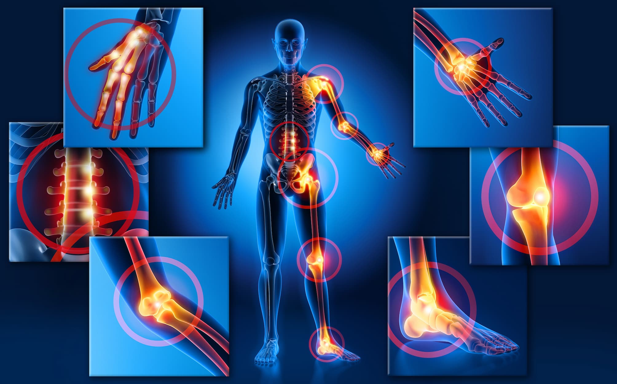 Fibromialgia 